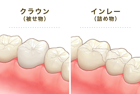 ジルコニア（クラウン／インレー）