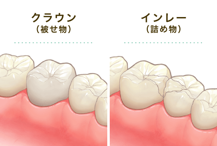 e-max（クラウン／インレー）