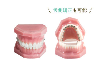 ワイヤー矯正（表側矯正／舌側矯正）