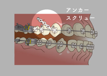 アンカースクリュー（補助装置）